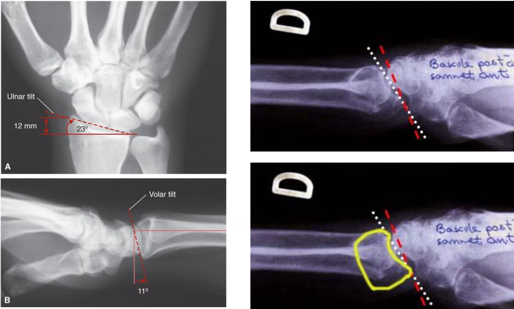 <p><strong>Impact clinique d’une bascule de l’ogive carpienne (surface articulaire du radius distal) post-fracture</strong></p><p><span style="color: rgb(192, 0, 0)">Position des fragments : </span></p><p><span>Bascule palmaire de l’extrémité distale du radius</span></p><ul><li><p><span>Bascule à sommet _____________ </span></p></li><li><p><span>Perte de ___________________ </span></p></li><li><p><span>Mvt de ____________ peut être </span>↑</p><p></p></li></ul><p><span>Bascule dorsale de de l’extrémité distale du radius </span></p><ul><li><p><span>Bascule à sommet </span>______________</p></li><li><p><span>Perte de ____________________</span></p></li><li><p><span>Mvt de ______________ peut être </span>↑</p></li></ul><p></p>