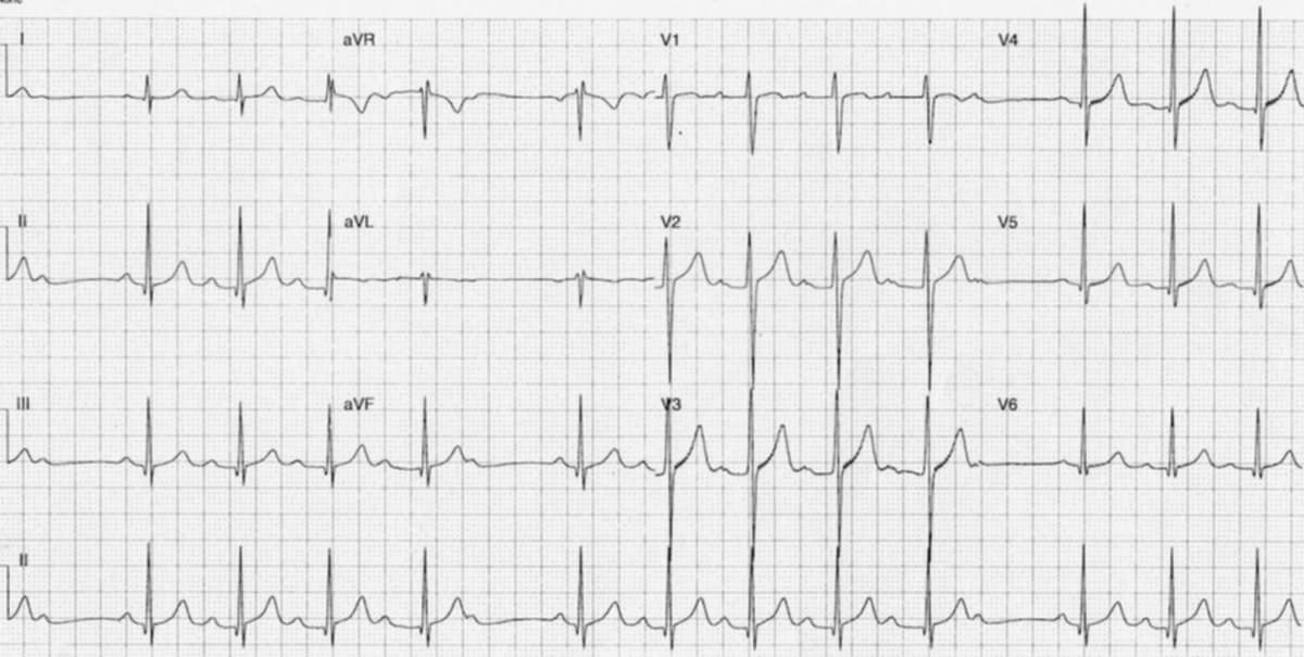 <p>what rhythm is shown in the ECG?</p>