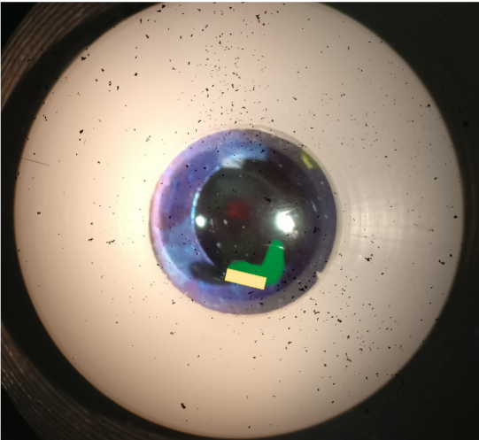 <p>beam shows 1mm slit length</p><p>what measurement would you record for this bit of the lesion</p>
