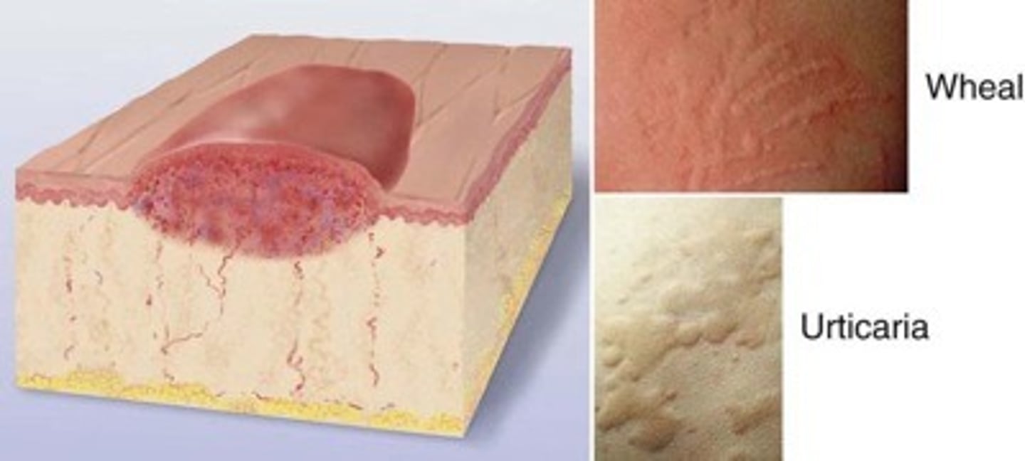 <p>Wheal: superficial, raised, erythematous with irregular shape due to edema (mosquito bite, allergy reaction)</p><p>Hives: a collection of wheals due to extensive reaction</p>