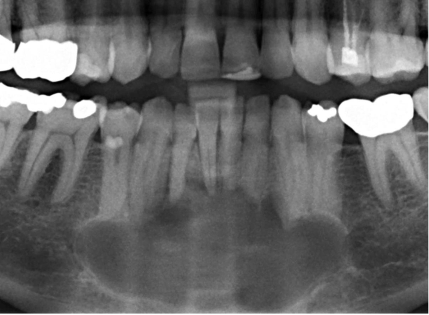 <p>A 35-year-old woman presented with the chief complain of asymptomatic swelling in the lower front region of jaw since 4 months. On clinical examination, hard swelling was present on body of mandible in relation to 33 to 43, obliterating the buccal vestibule and measuring about 1.5 cm in diameter. On palpation, the lesion was nontender, with no discharge, and the overlying mucosa was normal. Provide DD</p>