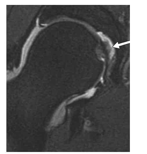 <p>Ligamentum Terres Tear: MOI</p><ul><li><p>What are the 4 main MOI?</p></li></ul><p></p><p></p>