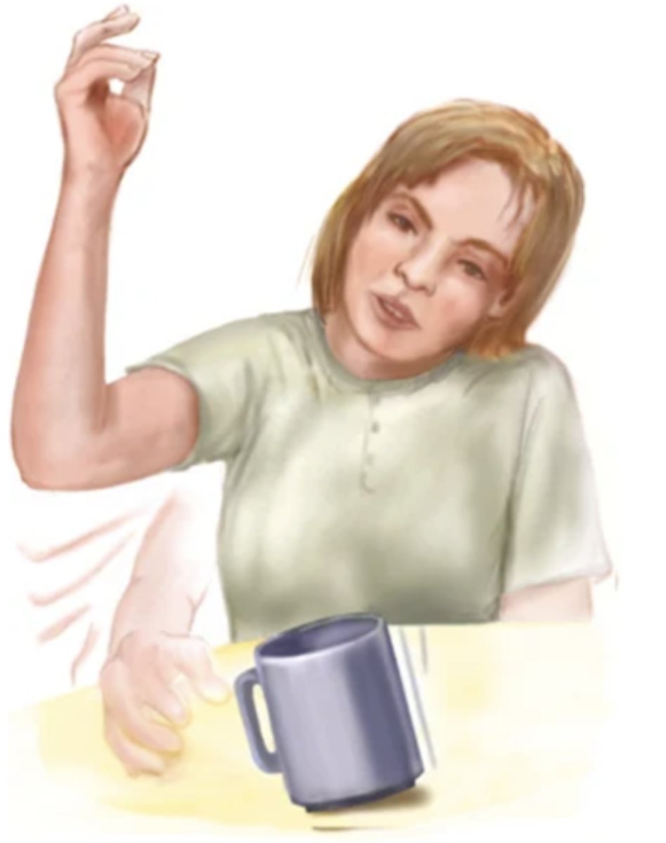 <p>Purposeless movements; jerky, sudden, and increases with voluntary movements; disappears with sleep</p>