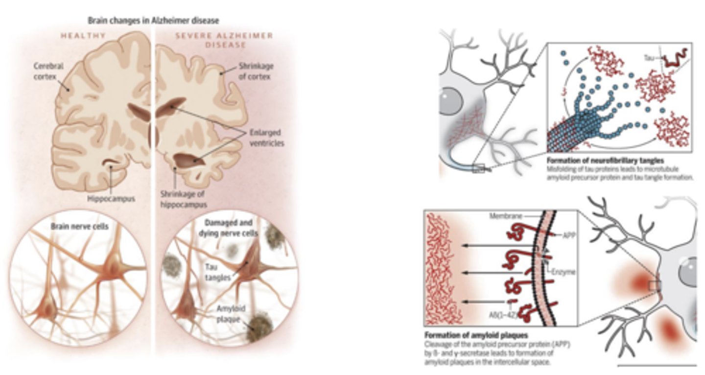 <p>- Mechanism is not well understood, but neuronal death caused by amyloid plaques and tau tangles is associated</p><p>- has been proposed that approximately 70% of risk is genetic</p>