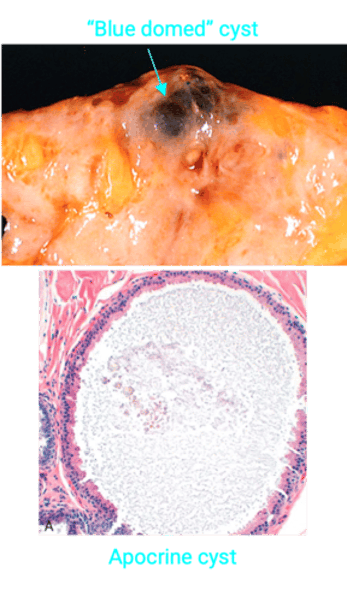 <p>Define Condition:</p><p>MC Benign Breast Lesion - Group of benign breast changes/lesions that have fibrosis or cysts in breast</p><p>-Hx: MC in Premenopausal Women (20-50 y/o)</p><p>-Path: Hormone mediated (cyclic/a/w menstrual cycle)</p><p>-Sx/PE:</p><p>&gt; Lumpy bumpy breast</p><p>&gt; Breast Tenderness</p><p>&gt; Bilateral &amp; Multifocal</p><p>-Prog: NO INC RISK OF CANCER</p><p>&gt; Cysts</p><p>&gt;&gt; Dilated fluid filled cysts in TDLU</p><p>&gt;&gt; Gross = "Blue Dome"</p><p>&gt; Stromal Fibrosis = Cysts rupture -&gt; inflammation and fibrosis</p><p>&gt; Apocrine Metaplasia/Change = Duct epithelial cells have abundant granular eosinophilic cytoplasm</p><p>&gt; Adenosis = Increased acini per lobule</p>