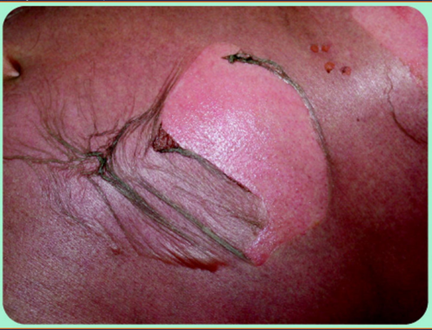 <p>POSITIVE</p><p>Flaccid</p><p>epidermal</p>