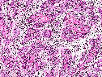 <p>Squamous cell carcinoma of the Conjunctiva and Cornea</p><p>N/E: Thickened well-demarcated leukoplakic lesion at the corneal limbus extending into the corneal center. M/P:</p><p>1.Replacement of the epithelium by atypical cells.</p><p>2.Mitoses are common.</p><p>3.Usually “insitu or intra-epithelial neoplasia”.</p><p>4.Occasionally invade deeper structures with central keratinization.</p>
