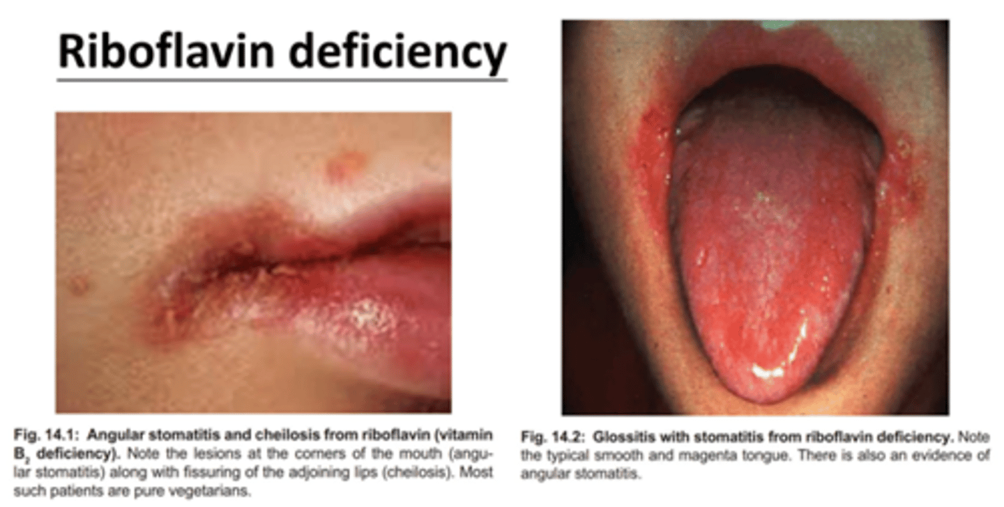 <p>Ariboflavinosis</p>