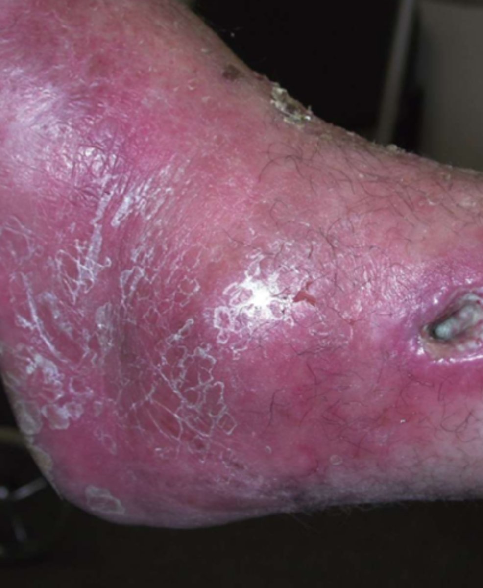 <p>S/Sx:</p><p>- erythema</p><p>- edema</p><p>- change in character/increase in drainage</p><p>- change in pain</p><p>- increased odor</p><p>- fever</p><p>- altered mental status</p><p>- increased WBC count</p><p>- delay in healing</p><p>TREATMENT:</p><p>- systemic antibiotics</p><p>- removal of surface bacteria (if able)</p>