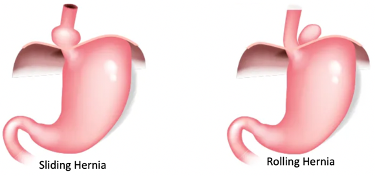 <p><span><span>-</span></span><span style="font-family: &quot;Times New Roman&quot;; line-height: normal; font-size: 7pt;"><span>&nbsp;&nbsp;&nbsp;&nbsp;&nbsp;&nbsp;&nbsp; </span></span>The protrusion of an organ, typically the stomach, through the oesophageal opening in the diaphragm.</p><p><span><span>-</span></span><span style="font-family: &quot;Times New Roman&quot;; line-height: normal; font-size: 7pt;"><span>&nbsp;&nbsp;&nbsp;&nbsp;&nbsp;&nbsp;&nbsp; </span></span>Common symptoms include heartburn, epigastric or chest pain, and difficulty swallowing.</p><p><span><span>-</span></span><span style="font-family: &quot;Times New Roman&quot;; line-height: normal; font-size: 7pt;"><span>&nbsp;&nbsp;&nbsp;&nbsp;&nbsp;&nbsp;&nbsp; </span></span>It is a common cause of gastro oesophageal reflux disease.</p><p>Type 1 (Sliding): the stomach and lower oesophagus slide up and into the chest through the diaphragm.</p><p>Type 11 (Rolling): part of the stomach protrudes through the diaphragm next to the oesophagus.</p><p></p>