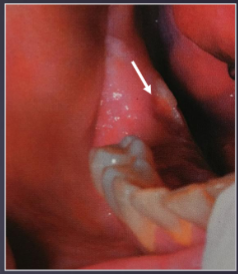 <p>a piece of necrotic bone that has become separated from healthy bone</p>