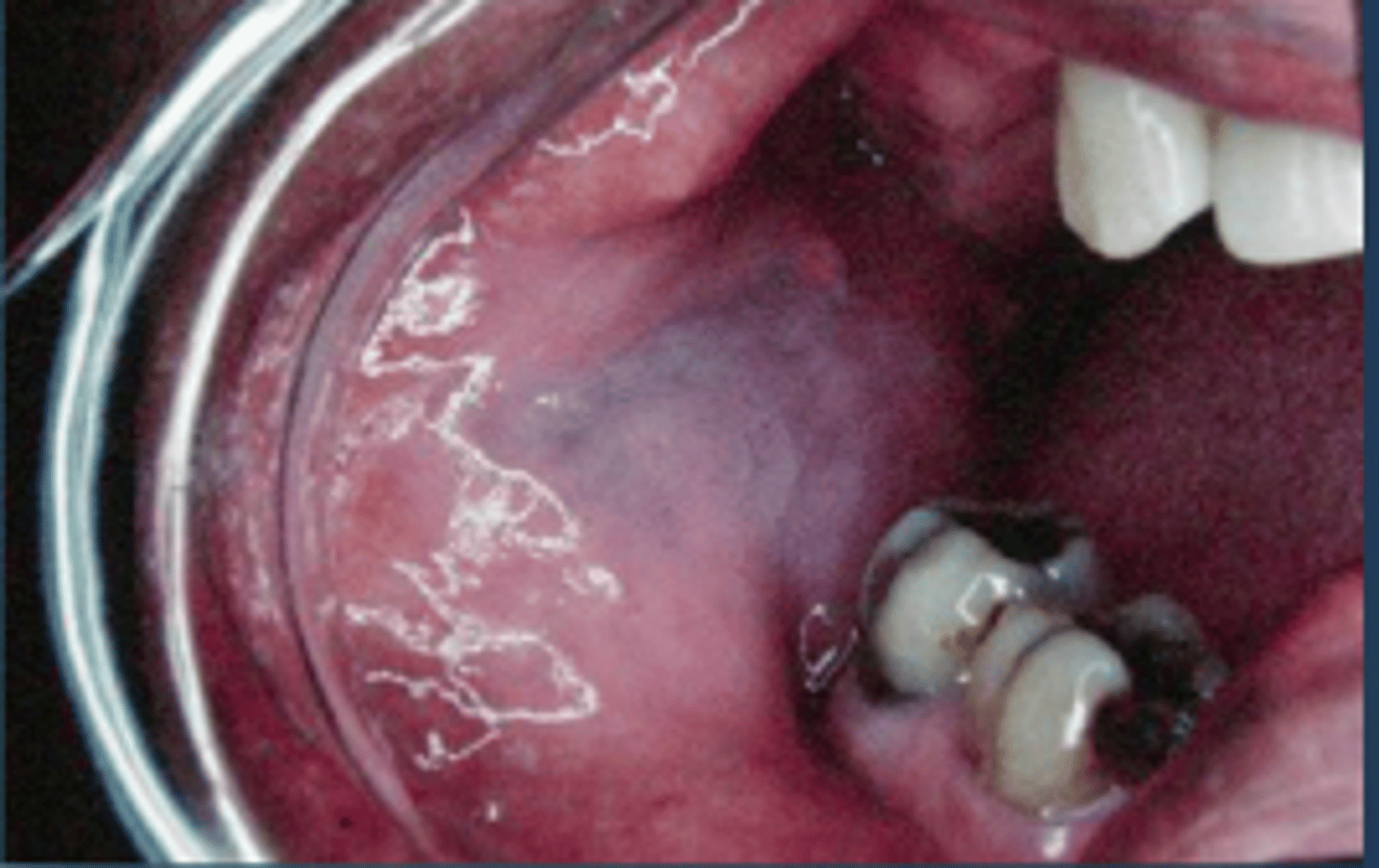 <p>-generalized opalescence on the buccal mucosa</p><p>-most commonly found in black adults</p><p>-when mucosa is stretched, opalescence is less prominent</p><p>-no tx</p>
