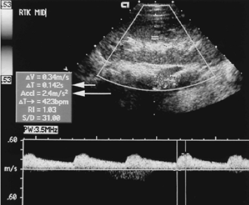<p> Is the sonographer correct documenting the RI is 1.03?  Please explain. </p><p>If we estimate the EDV is 14 cm/sec, what is the RI  using RI formula. Please include formula in your answer. </p>