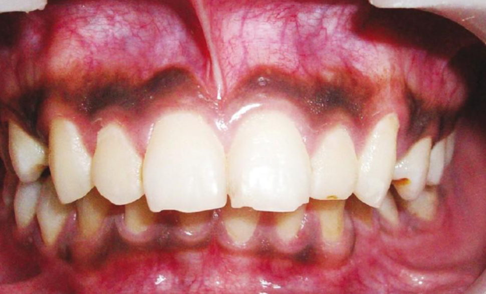 <p>melanin pigmentation of oral mucosa/gingiva</p>