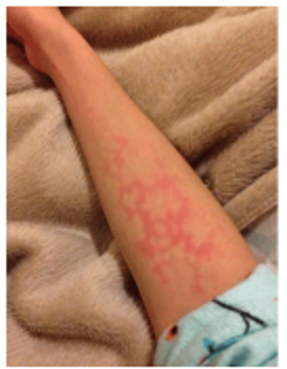 <p>Excessive or prolonged TTR will result in a rebound vasoconstriction (vasospasms) that is visually manifested by mottling → Pt can't disperse heat.</p><p>The release of massive amounts of chemical mediators such as histamine, prostaglandin, and bradykinin (potent vasodilator) will cause the transient paralysis of arteriole-sized vessels resulting in spasms and vasoconstriction.</p>