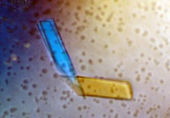 <p><span>2+ criteria met:</span><br><span>1. monoclonal gammopathy</span><br><span>2. lytic bone lesions</span><br><span>3. bence jones proteinuria</span><br><span>4. bone marrow plasmacytosis</span></p>