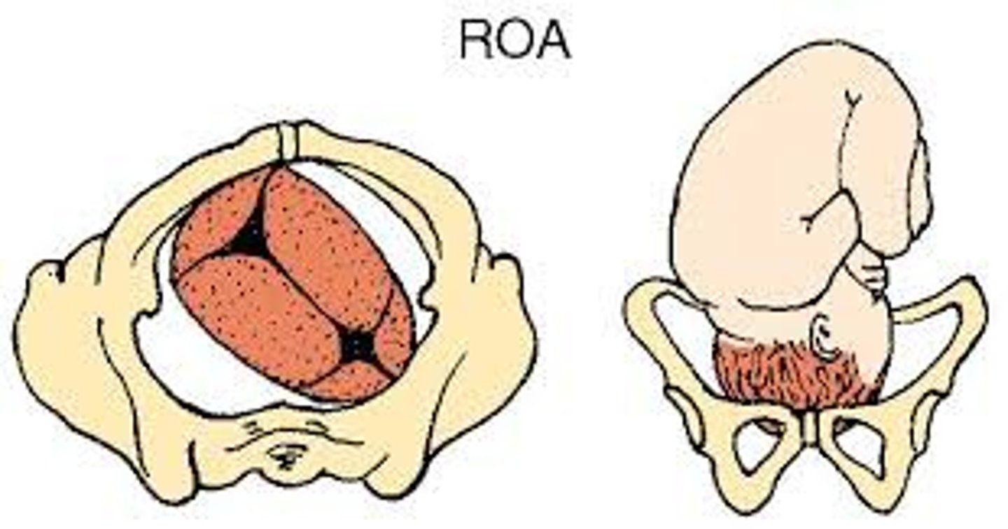 <p>parto de nalgas</p>