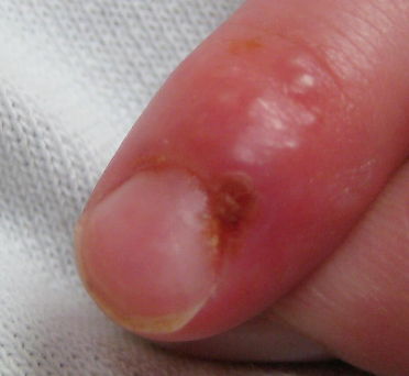 <p>What are prodromal signs in herpes infection?</p>