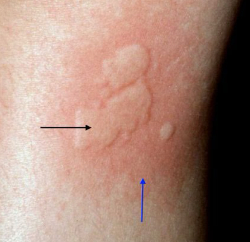 <p>what lesion is depicted by the black arrow</p>