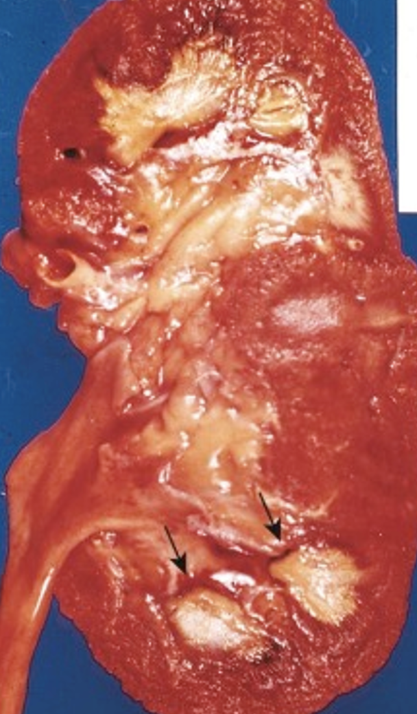 <p>What complication of an acute pyelonephritis is shown at the arrows?</p>