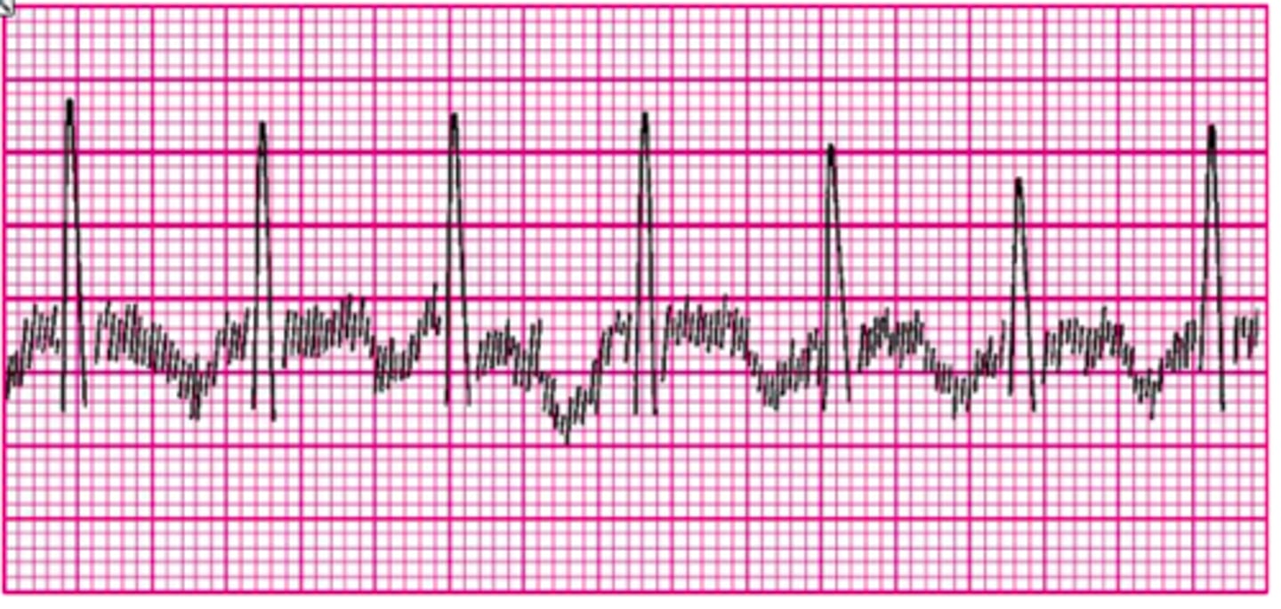 <p>electronic devices on or near a patient causing an electrical interference</p>