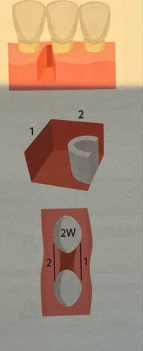 <p>This is a form of Infrabony pocket. When it is bordered by 2 osseous surfaces and 2 tooth surfaces.</p>