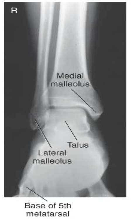 <p><span style="line-height: normal;"><span> </span></span>Distal ⅓ of tibia and fibula demonstrated</p><p class="p1"><span style="line-height: normal;"><span> </span></span>Proximal ½ of metatarsals included</p><p class="p1"><span style="line-height: normal;"><span> </span></span>Medial and superior aspect of Mortise joint open</p><p class="p1"><span style="line-height: normal;"><span> </span></span>Lateral distal tibia+ lateral talus superimposed over fibula</p><p class="p1"><span style="line-height: normal;"><span> </span></span>Closed lateral Mortise joint</p>