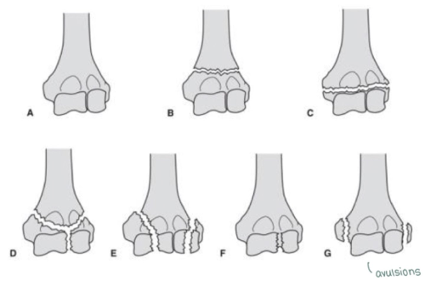 <p>- supracondylar fx (above condyles)<br>- transcondylar fx (transverse line through condyles)<br>- intercondylar fx (fx IN BETWEEN condyles, vertical line)<br>- condylar fracture (condyles broken off)<br>- articular fx (fx of articular surfaces)<br>- epicondylar fx (avulsion fx)</p>