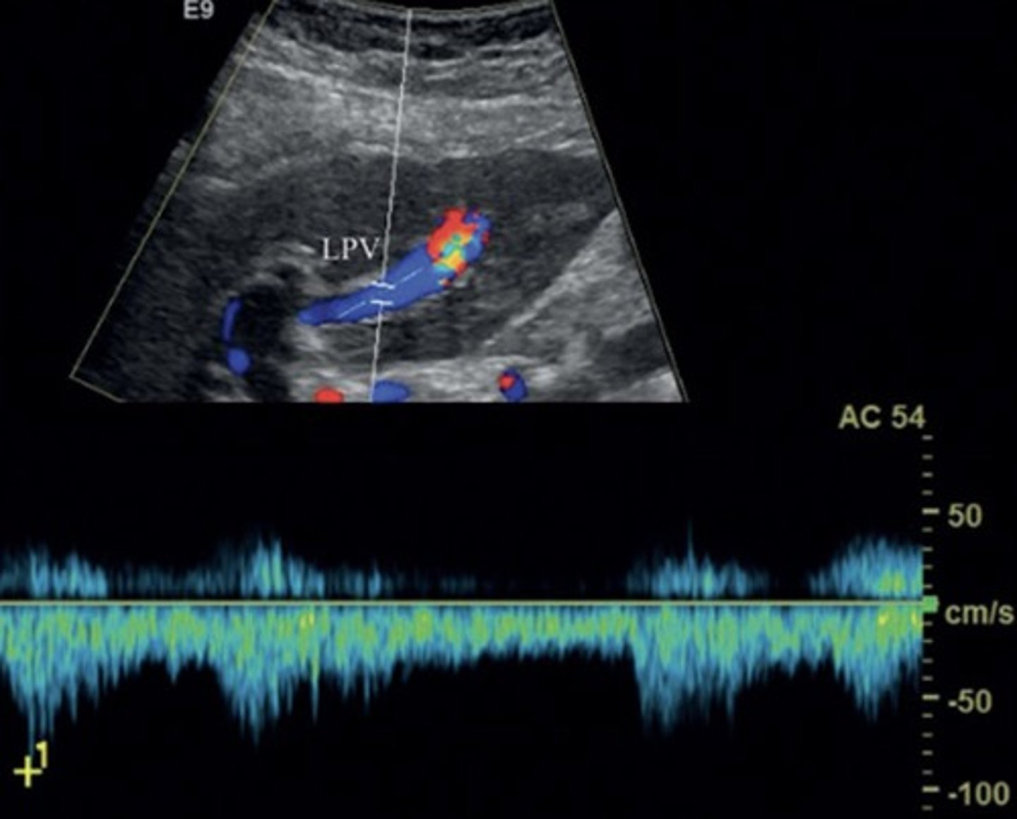 <p>Large anechoic spaces</p><p>Increased portal vein pulsatility &amp; velocities</p>