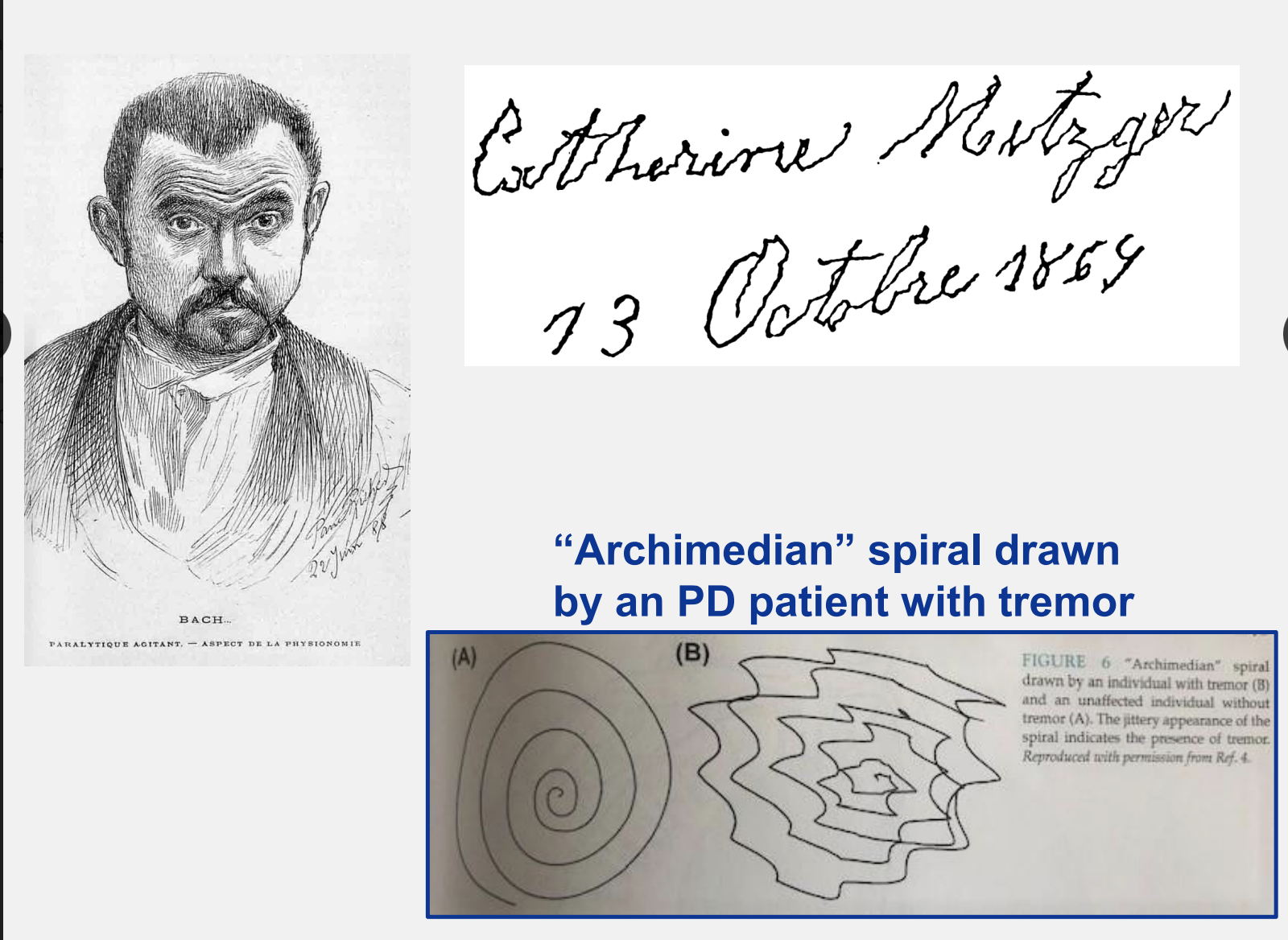  a movement disorder with symptoms of resting tremor, slow movement, slow speech, rigidity (noticable things when you see a person) and the second most common neurodegenerative disease

* distinguishable “Archimedian” spiral drawn by a PD pt with tremor