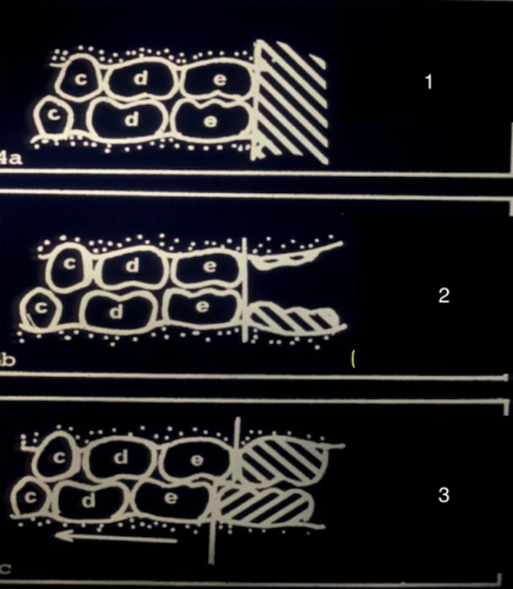 <p>What type of terminal plane is seen in the primary dentition (1)?</p>