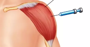 <p>origin: clavicle, trapezius, acromion</p><p>insertion: deltoid tuberosity of the humerus</p><p>function: lifts arms at shoulders </p>