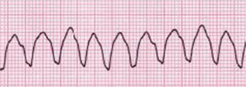 <p>Ventricular tachycardia - <span>occurs when the lower chamber of the heart beats too fast to pump well and the body doesn't receive enough oxygenated blood </span></p>