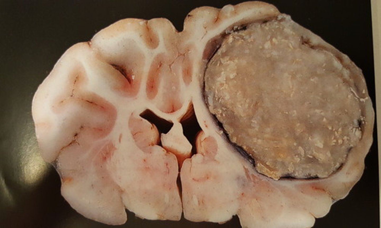 <p>Hjerne fra får. Patoanatomisk diagnose? Hvordan kan læsionen opstå?</p>