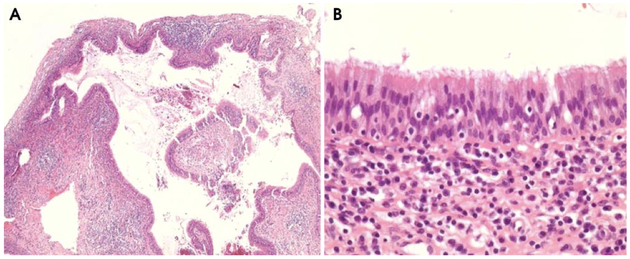 <p>A 42-year-old woman came complaining of intermittent stinging pain in her right cheek. There were no clinically abnormal findings in physical and oral examinations. The patient only had a history of orthognathic surgery on both the maxilla and the mandible performed about 21 years prior to this visit</p>