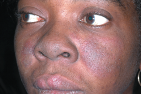 <ul><li><p>discoid rash: erythematous raised patches w/ adherent keratotic scaling + follicular plugging</p></li><li><p>malar rash: fixed erythema, flat/raised, over malar eminences </p></li></ul><p></p>