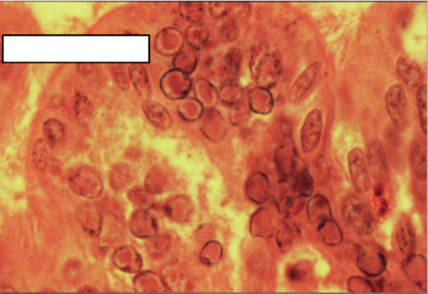 <p>fusion of multiple host cells into single large cells containing multiple nuclei</p>
