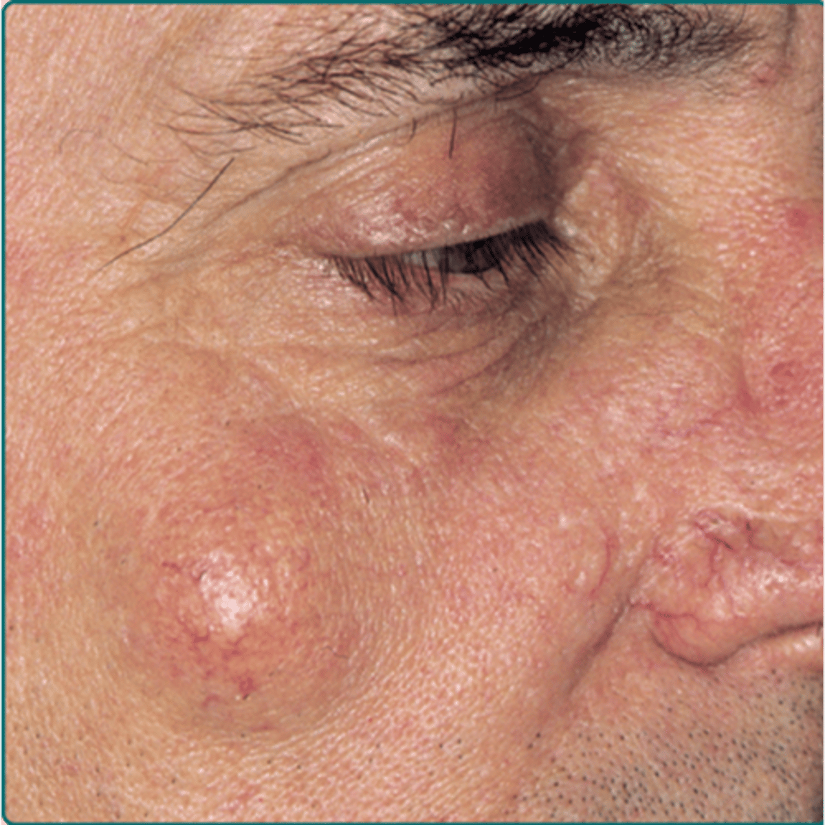 <p>name this skin pathology</p>
