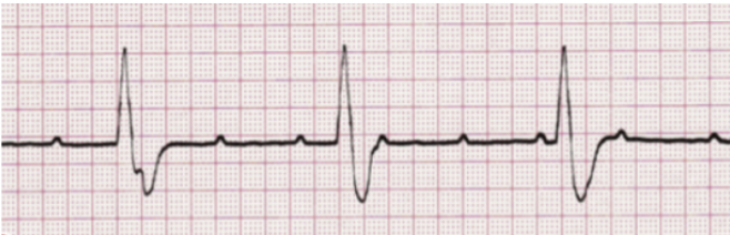 <p>Identify what type of heart block is shown! Discuss symptoms </p>