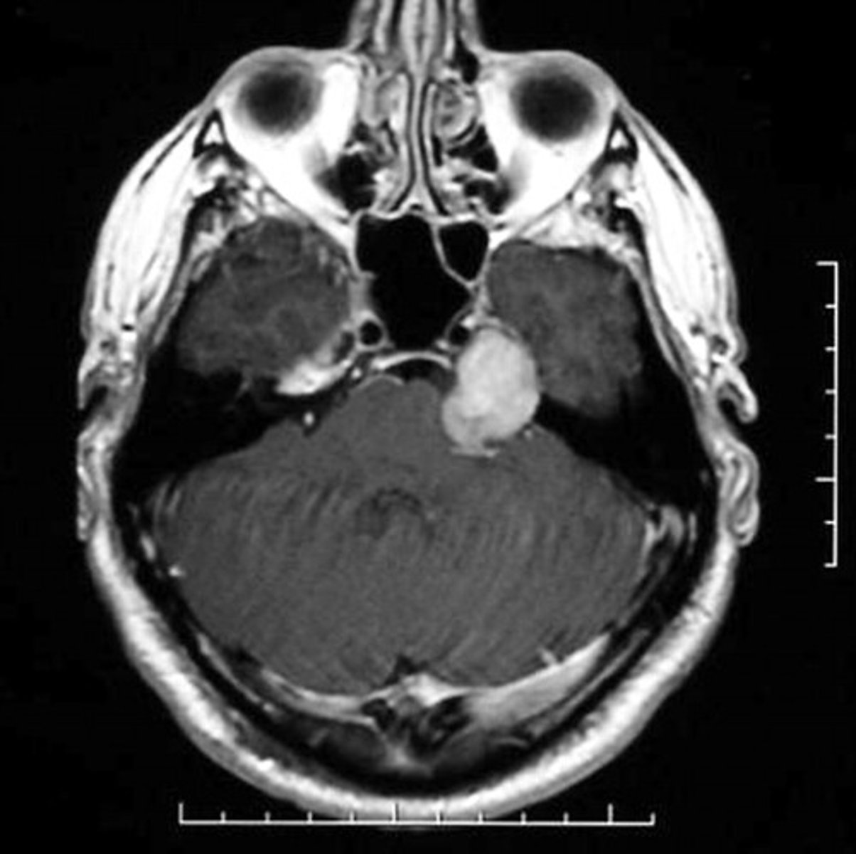<p>Vestibular (aka acoustic neuroma - leads to hearing issues such as hearing loss, tinnitus, etc.)</p>