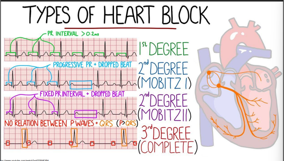 <p>1st degree: PR interval is greater than 0.2ms </p><p>2nd degree (Mobitz I): progressive PR + dropped beat</p><p>2nd degree (Mobitz II): Fixed PR interval + Dropped beat </p><p>3rd degree: No relation between P waves + QRS</p>