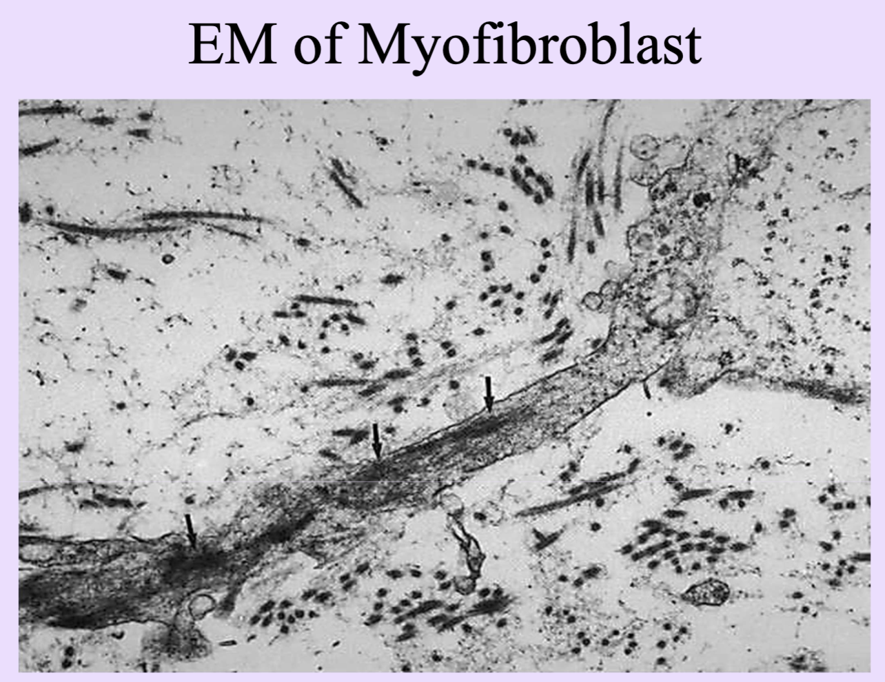 <p>Contractile fibroblasts that pull wound margins together during healing.</p><ul><li><p>Enables proliferating epithelial cells to cover surface defect</p></li></ul><ul><li><p>First few days, properties of smooth muscle cells and fibroblasts</p></li></ul><p></p>
