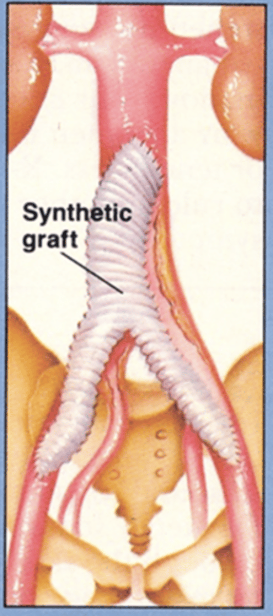 <p>Scars in abdomen &amp; each groin</p>