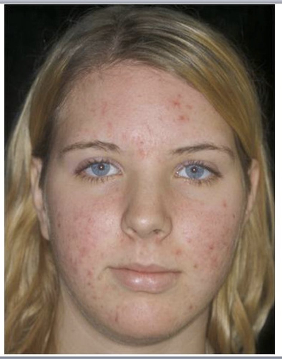 <p>many closed comedones, more open comedones and occasional papules and pustules</p>
