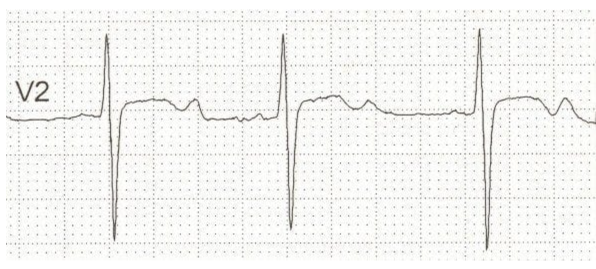 <p>18 y/o male presents to the ER for HA and visual changes. He also reports N/V. Vitals are stable with the exception of BP 180/112. See rhythm strip. Labs show hypokalemia, elevated plasma aldosterone and low plasma renin. What is your next step?</p>