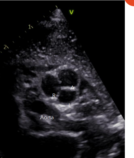<p>The Pulmonic Valve is obtained in what view, with what o’clock rotation of the probe?</p>