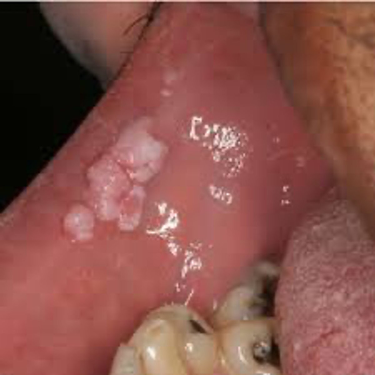 <p>Multiple pink, sessile lesions in the oral cavity are most likely:</p>