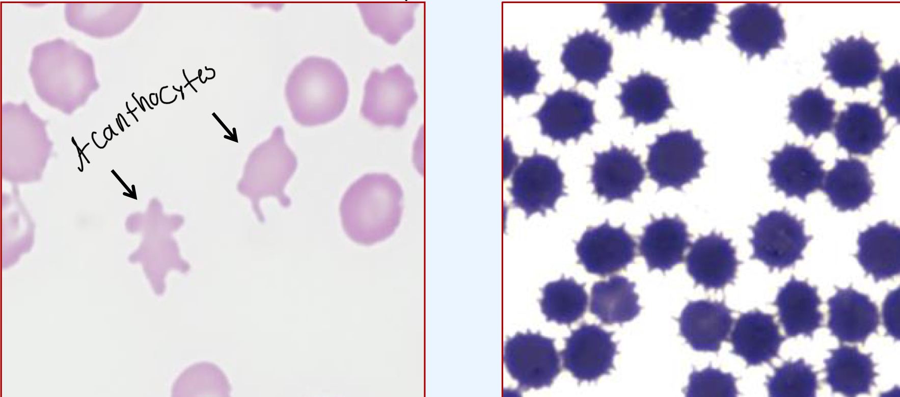 <p>Acanthocytes can appear similar to the RBCs in the image on the right, what is the name for these RBCs?</p>