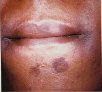<ul><li><p>Identify the disease</p></li><li><p>Clinical feature</p></li></ul><p></p>