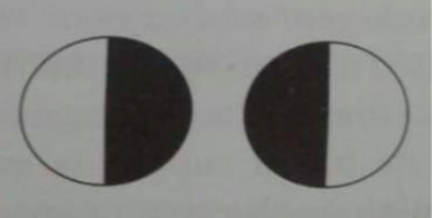 <p>-may be due to ICA aneurysms</p><p>-lesion at one side of the optic chiasm</p>